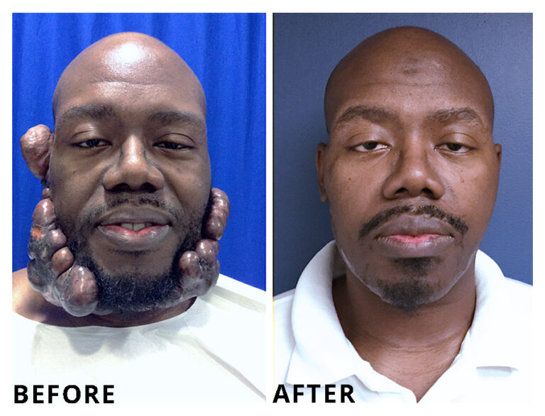 1-keloid-specialists-scar-removal-expert-doctor-keloid